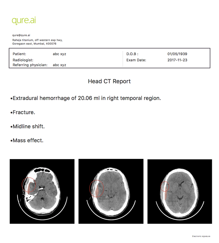 Qure.ai launches AI system to read head CT scans and find abnormalities