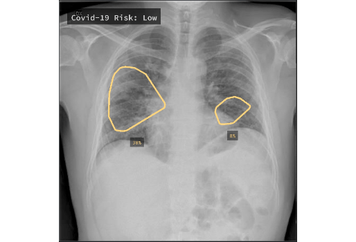 Chest X-Ray screening for COVID-19